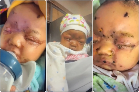 မိဘ ၂ ဦးလုံး သေဆုံးပြီး ထိခိုက်ဒဏ်ရာရထားတဲ့ ဗန်းမော်မြို့နယ် ထီးလင်း ကောင်ဂျာရွာက လသားအရွယ်ကလေးငယ်